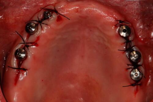 1-conical-grade-sg-implant-vittorio-danniballe-(1)