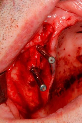 1-conical-grade-sg-implant-vittorio-danniballe-(12)