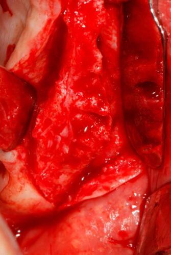 1-conical-grade-sg-implant-vittorio-danniballe-(3)