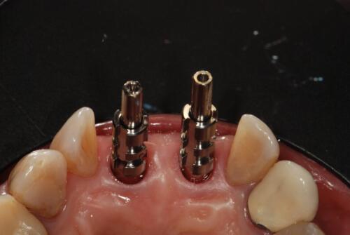 3-conical-grade-sg-implant-vittorio-danniballe (1)