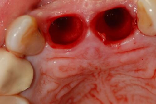 3-conical-grade-sg-implant-vittorio-danniballe (10)