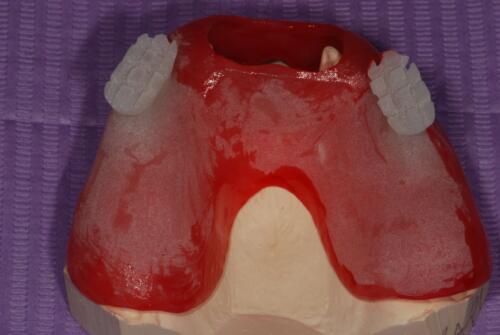 3-conical-grade-sg-implant-vittorio-danniballe (2)