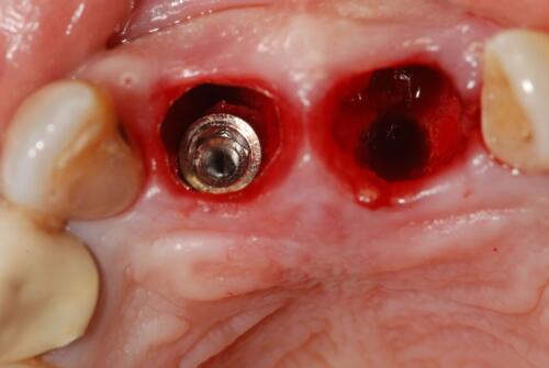 3-conical-grade-sg-implant-vittorio-danniballe (20)