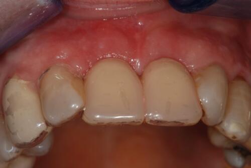3-conical-grade-sg-implant-vittorio-danniballe (21)