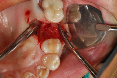 4-conical-grade-sg-implant-vittorio-danniballe (21)