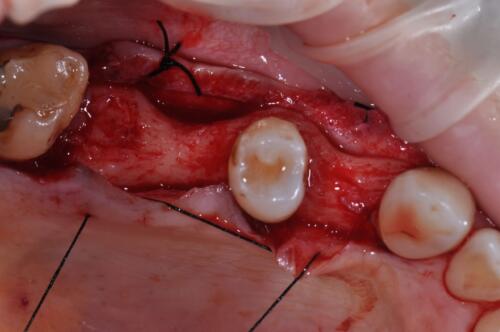 5-conical-grade-sg-implant-vittorio-danniballe (2)