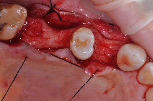 5-conical-grade-sg-implant-vittorio-danniballe (3)