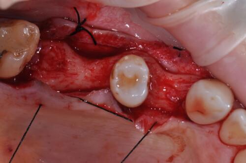 5-conical-grade-sg-implant-vittorio-danniballe (4)