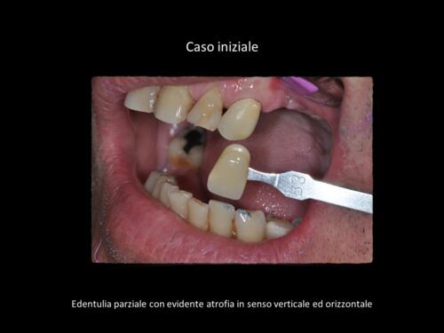 Messina-M. Conical-Grade-Diapositiva3