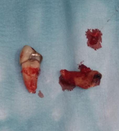dott.-domenico-di-croce-sg-implant-vittorio-danniballe (12)