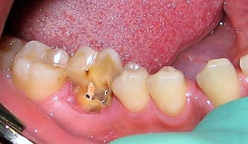 post-estrattivo-conical-grade-sg-implant-vittorio-danniballe (1)
