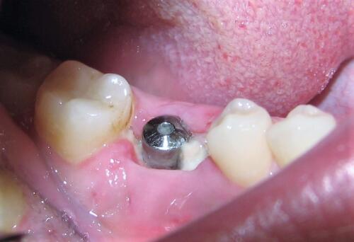 post-estrattivo-conical-grade-sg-implant-vittorio-danniballe (10)
