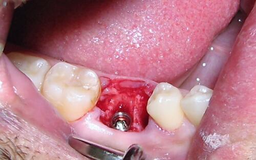 post-estrattivo-conical-grade-sg-implant-vittorio-danniballe (6)